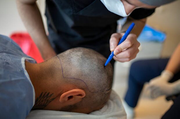 The Cost of Hair Transplants: What Influences Pricing?