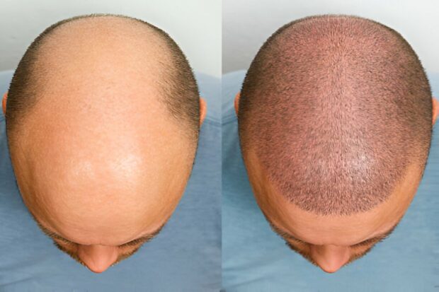 DHI Hair Transplant in Turkey Procedure, Costs & Benefits
