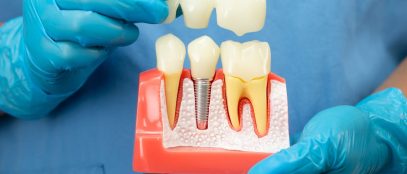 Dental Crown Problems Causes, Fixes and What You Might Pay