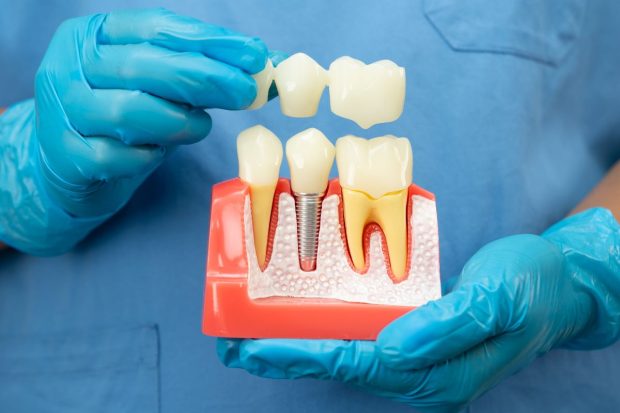 Dental Crown Problems Causes, Fixes and What You Might Pay