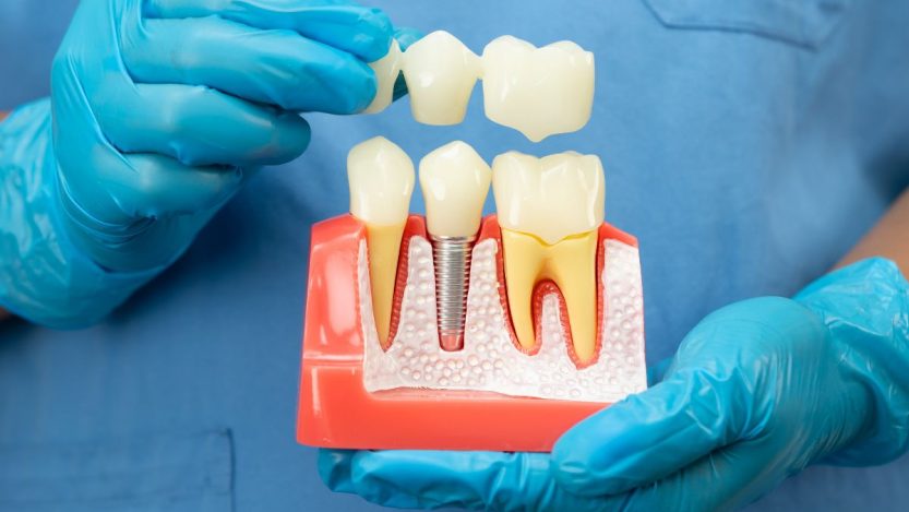 Dental Crown Problems Causes, Fixes and What You Might Pay